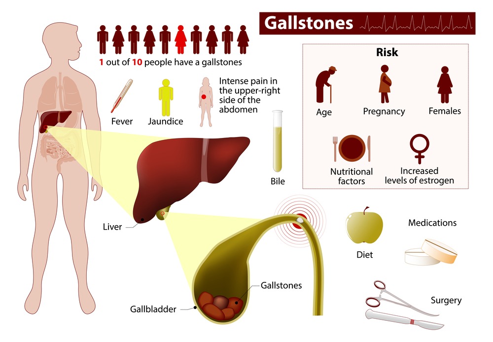  gallbladder causes gallstones