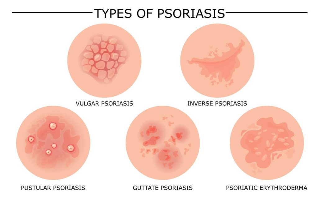 Eczema Comes In A Variety Of Forms