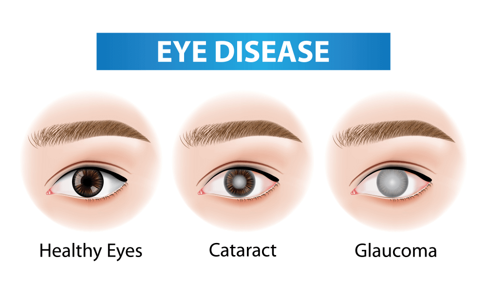 How Are Glaucoma And Cataracts Different